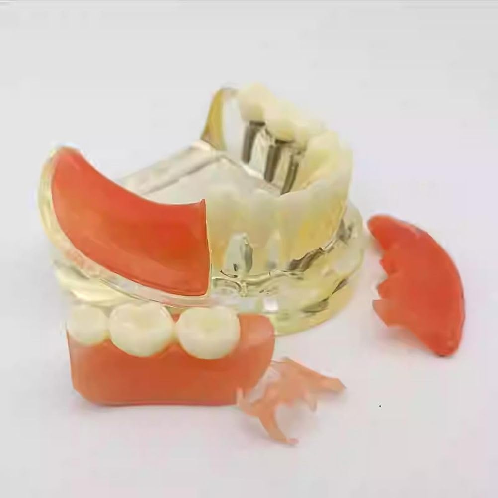 Implant-Supported Restorations Comparison Model Transparent Dental Implant Model Education Study