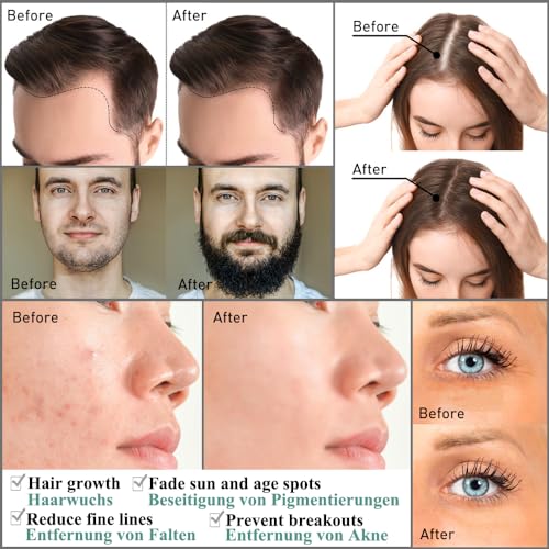 Zemolo 2Pcs Derma-Roller 1mm with 1.5mm, Beard Roller Microneedling Roller with 540 Needles, Micro-Needles, Derma-Roller for Men & Women Hair Skin Face and Body, Wrinkles - Image 5