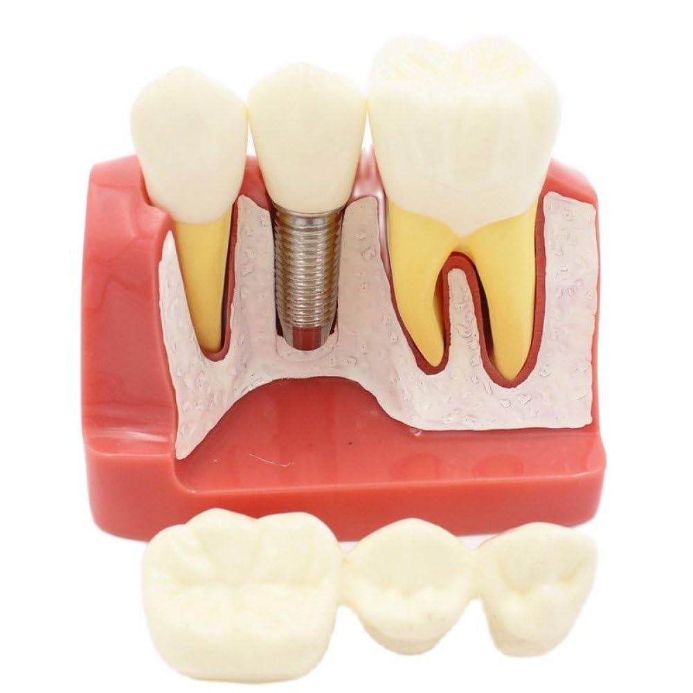 Modello di Impianto Dentale 4 Volte Modello di Denti Dimostrativo Ingrandito Modello di Denti Didattici Modello di Analisi Rimovibile Ponte della per Studente di Odontoiatria