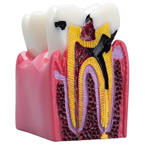 LVCHEN Dental Caries Teeth Model - Anatomy Education Model Caries Bilateral Comparison Study Model 6 Times Cross-Section Demonstration Model Tooth Decay Props for Science Teaching Cover