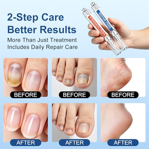 Image of Toenail Fungus Treatment Extra Strength - Fungi Nail Pen, 25% Undecylenic Acid, Fungal Nail Repair Kit for Damaged, Discolored, Yellow,Ingrown, Foot Repair Nails 5PCS