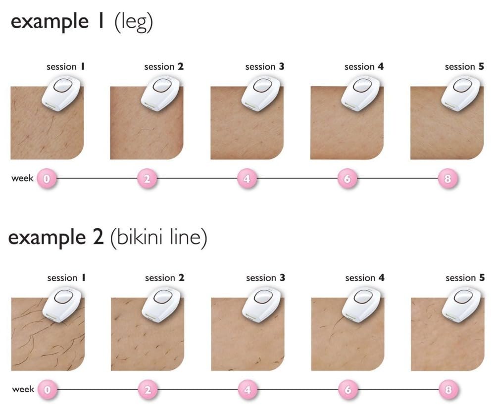 Solippy LOOP IPL Hair Removal Device (blanc)
