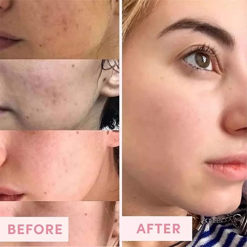 Vista 6 de 2% BHA Liquid Exfoliant Tratamiento del acné Suero facial Exfoliante facial para puntos negros, poros dilatados, arrugas líneas finas, cuidado