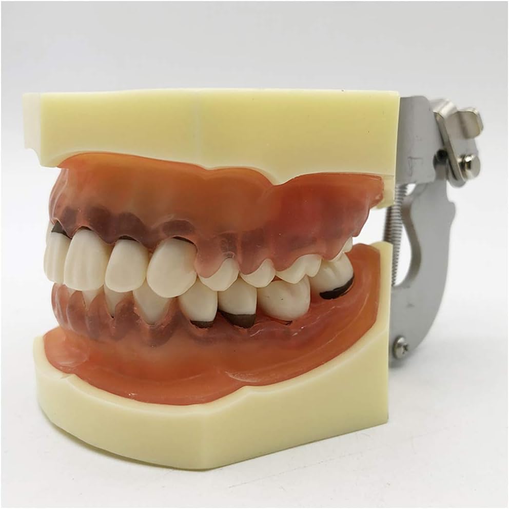 KH66ZKY Periodontal Pathology Dental Calculus Model Dental Pathology Teeth Model Removable Teach Demo with Gum : Industrial & Scientific