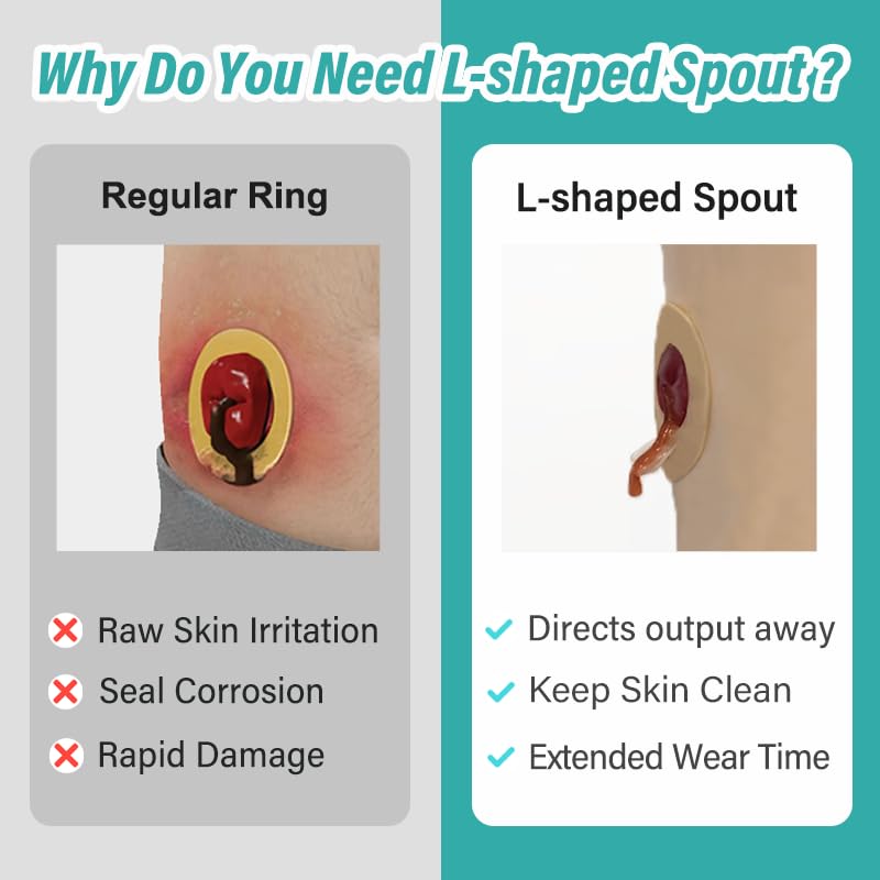 Ostomy Barrier Rings with L-shapped Output Direction Spout, Ostomy Stoma Rings with L-shapped Groove, Ostomy Supplies,Colostomy Supplies,4 Pcs/Pack (2mm Thickness, Diameter : 1.9 Inches)