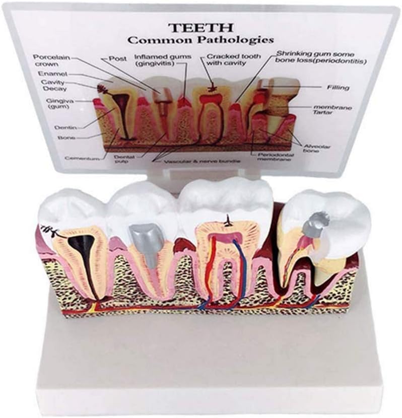 Modèle de section transversale des dents F détachable éducation médicale - 4