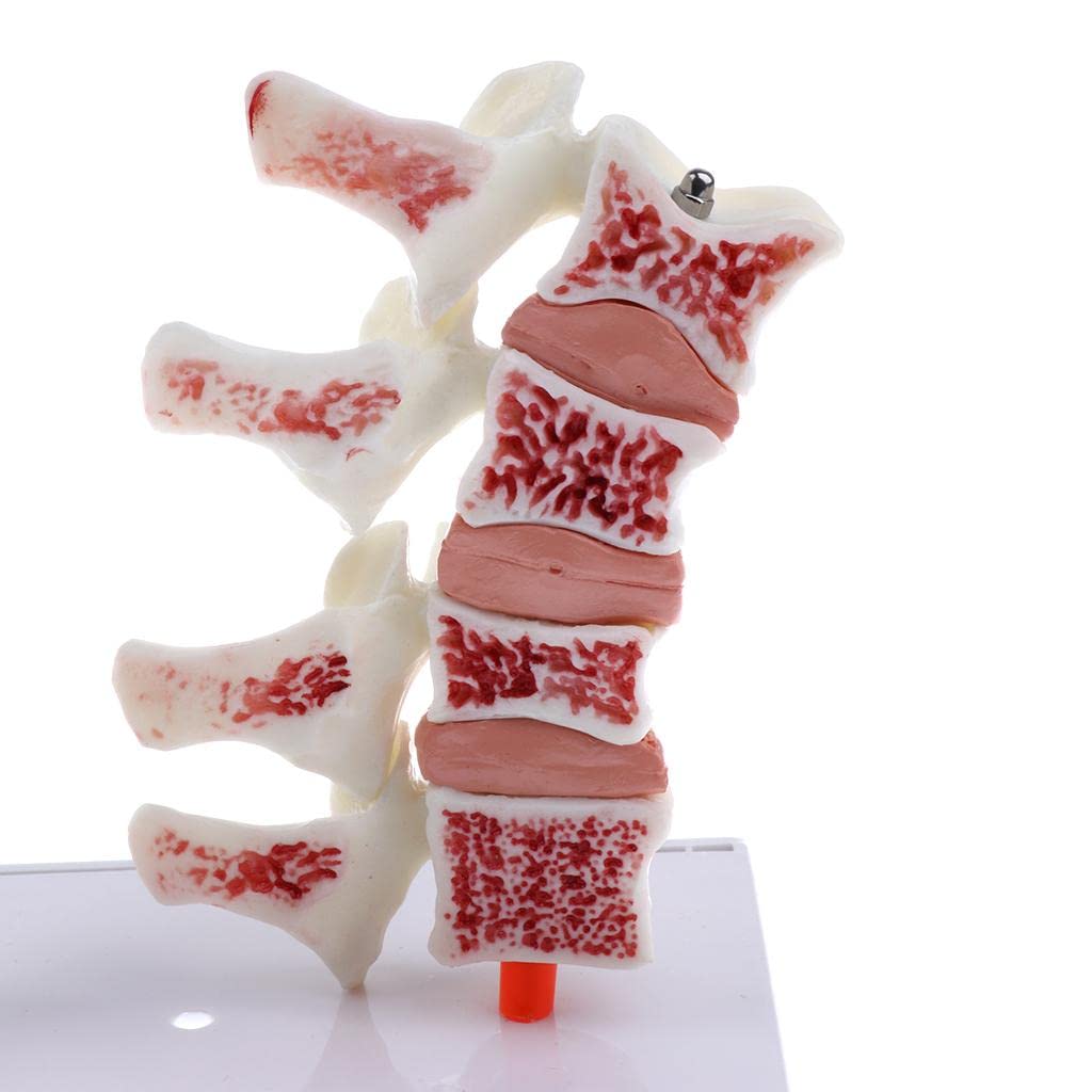 predolo 1: 1 Modellbausatz für Die Osteoporose des Menschlichen
