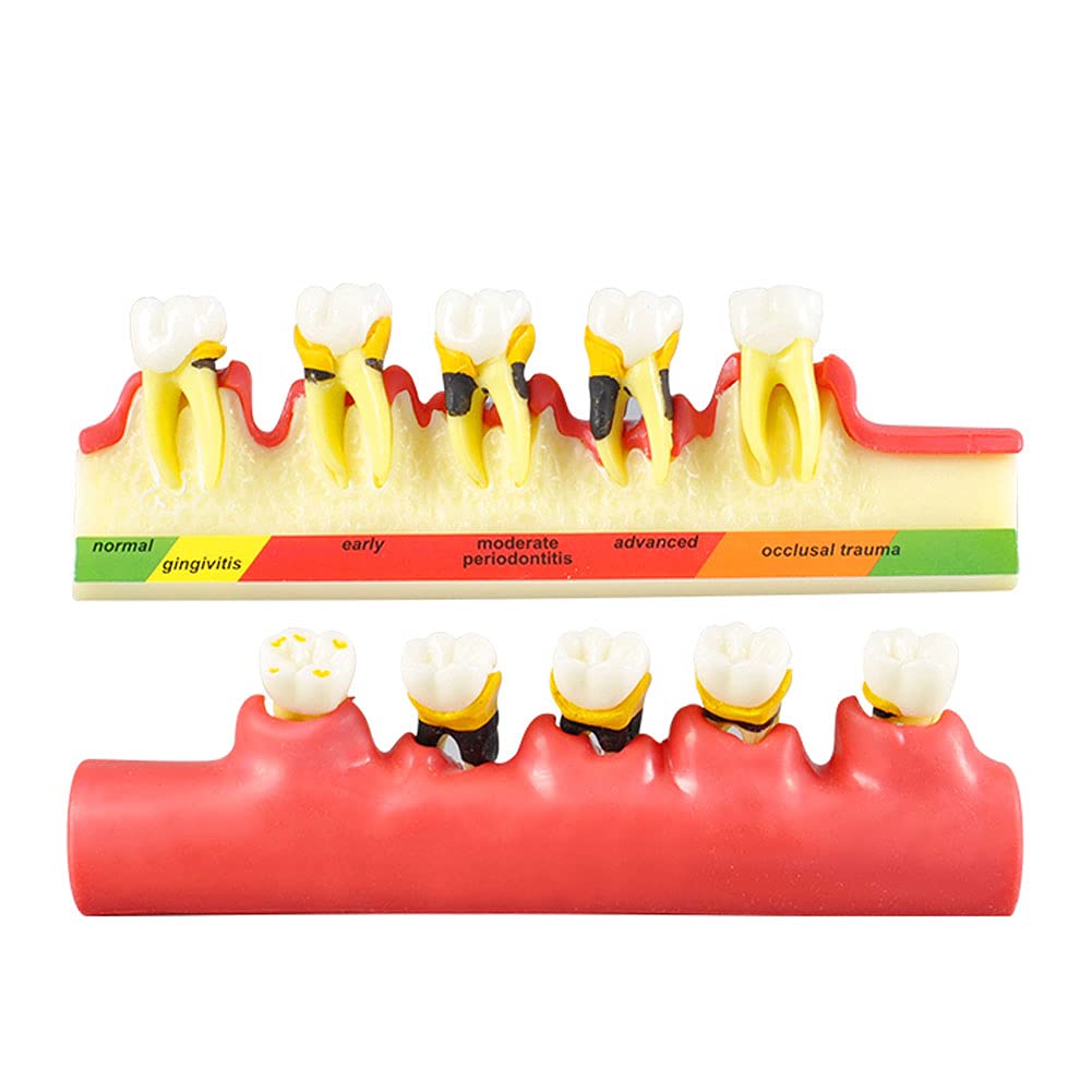 Buy Oral Dental Model, Dental Periodontal Disease Assort Educational