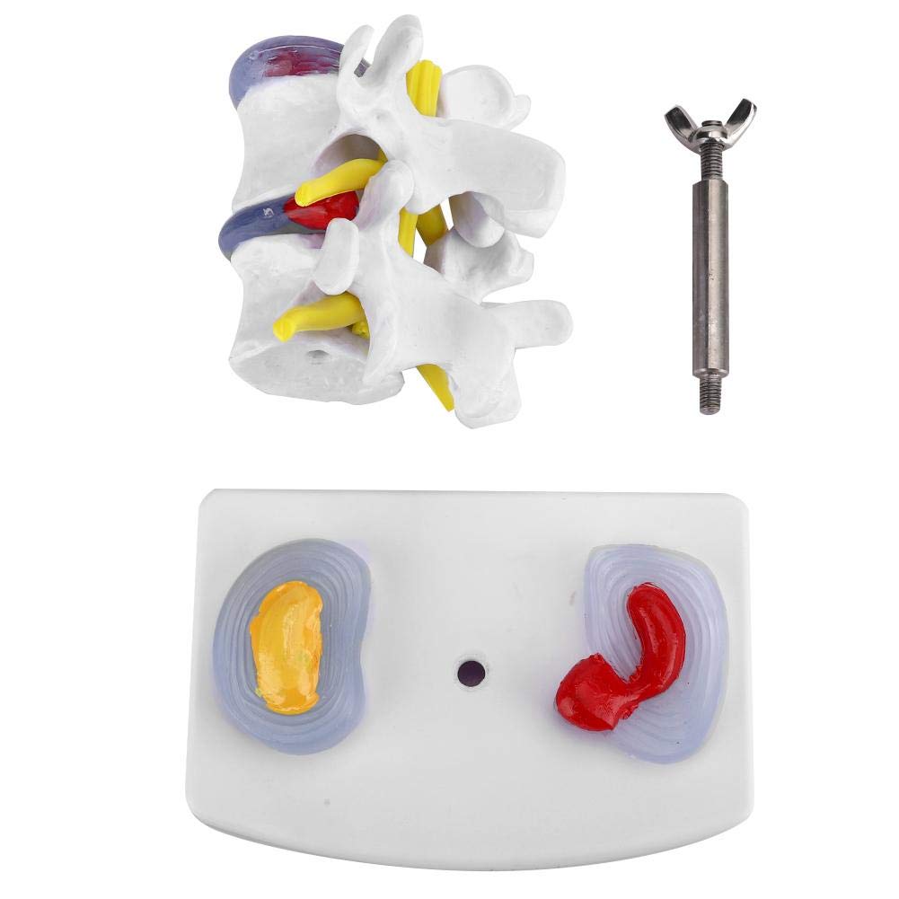 Lumbar Model Anatomical Lumbar Disc Herniation Demonstration Model Human Spine School Training Supplies