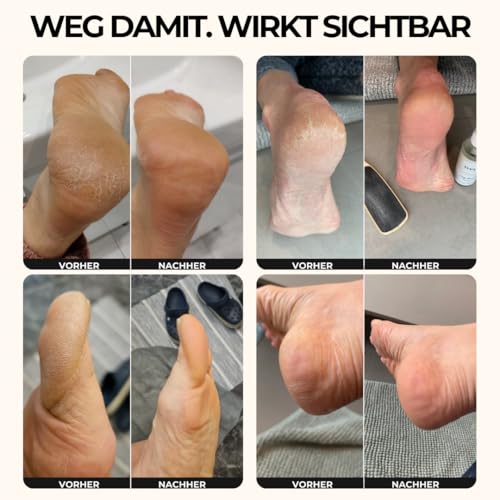 tvey\ weg damit: Hornhautentferner Spray mit Soforteffekt - Mittel gegen Hornhaut und trockene Haut - mit extra viel Urea für weiche Füße - Hornhautweicher Made in Germany 100ml Vegan