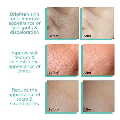 MonetBeauty-Adjustable-Microneedle-Derma-Stamp-025mm-3mm-140-Professional-Grade-Needles-Derma-Pen-for-Acne-Scars-and-Stretch-Marks-Effectively-Remove-Fine-Lines-and-Wrinkles