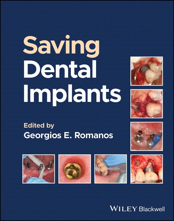 Saving Dental Implants (English Edition)