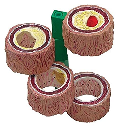Modèle d'anatomie de l'athérosclérose WXKAGF : visualisez le blocage artériel