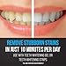 Starlite Smile Teeth Whitening Accelerator Light, 16x Powerful Blue LED Light Mouth Tray, Teeth Whitening Machine for Home Use, Connected with iPhone/Android/USB/USB-C, Teeth Whitener Light Gum Tray