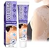 Vitiligo Treatment, Natural Vitiligo Cream, Effective Improve Skin Pigmentation & Fade Vitiligo, 0.7 Fl Oz