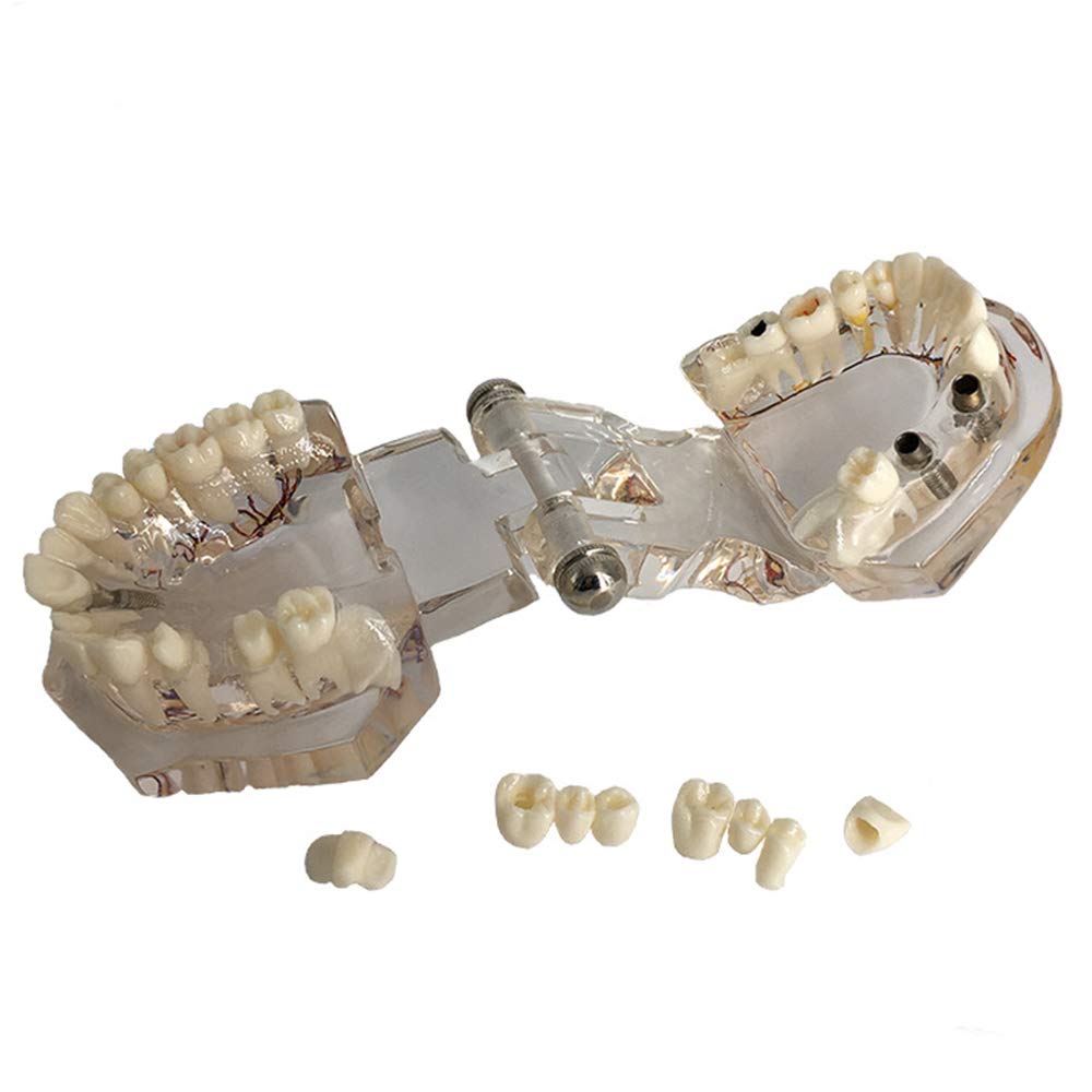 LA MALATTIA PARODONTALE – Studio Dentistico Dr. Andrea Viaggi - Foto 5