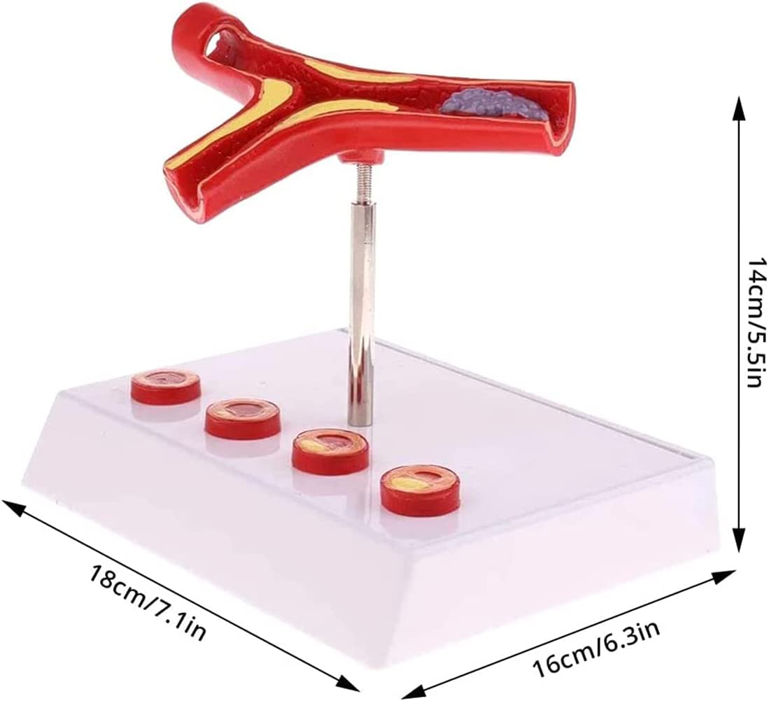 Modèle de Thrombus athéroscléreux vasculaire Humain avec Base Modèle pathologique cardiovasculaire Modèle médical Matériel pédagogique