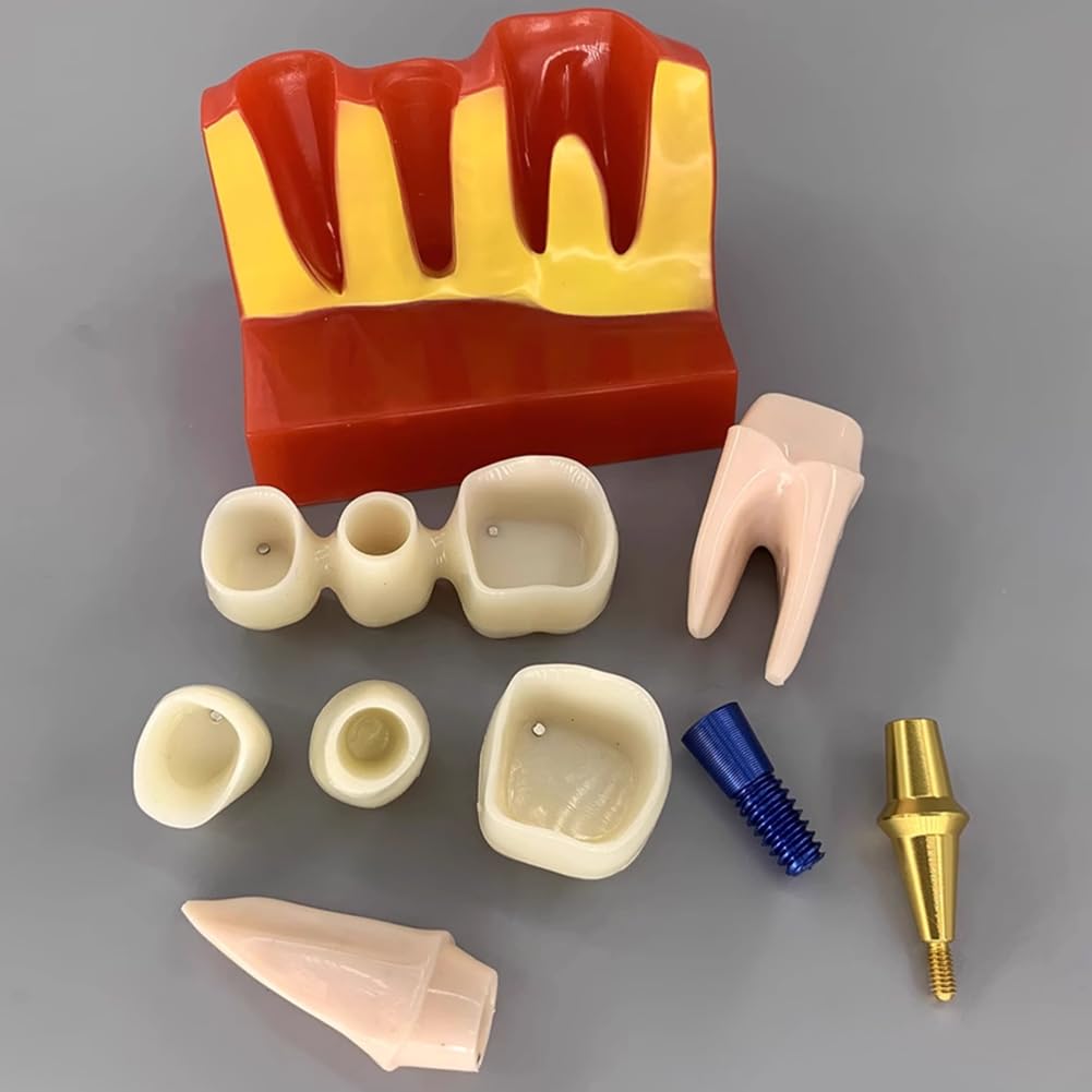 Fituenly Dental Implant Model - 4 Times Removable Analysis Crown Bridge Demonstration Teeth Model Dental Implant Analysis Tooth Model for Learning and Education