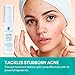 Acne Spot Treatment for Acne Prone Skin - Treats Cystic Acne, Advanced Acne Removal, Fast-Acting, Pimple Repair with Tea Tree Oil & Plant Extract, All Natural - 30g