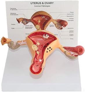 Educational Model Female Uterus Anatomical Model Uterine Ovary Lesion Model Pathological Internal Reproduction Organ Anatomy Model for Gynecology Medical Teaching,Medical Models SaiFei