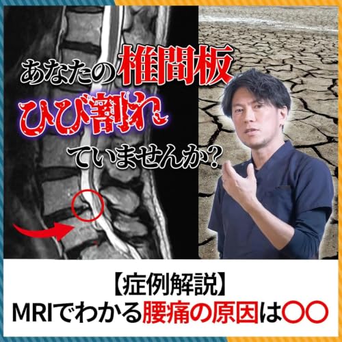 MRIで見えるひび割れは「隠れた腰痛」の原因かもしれません。実症例を紹介しながら解説！