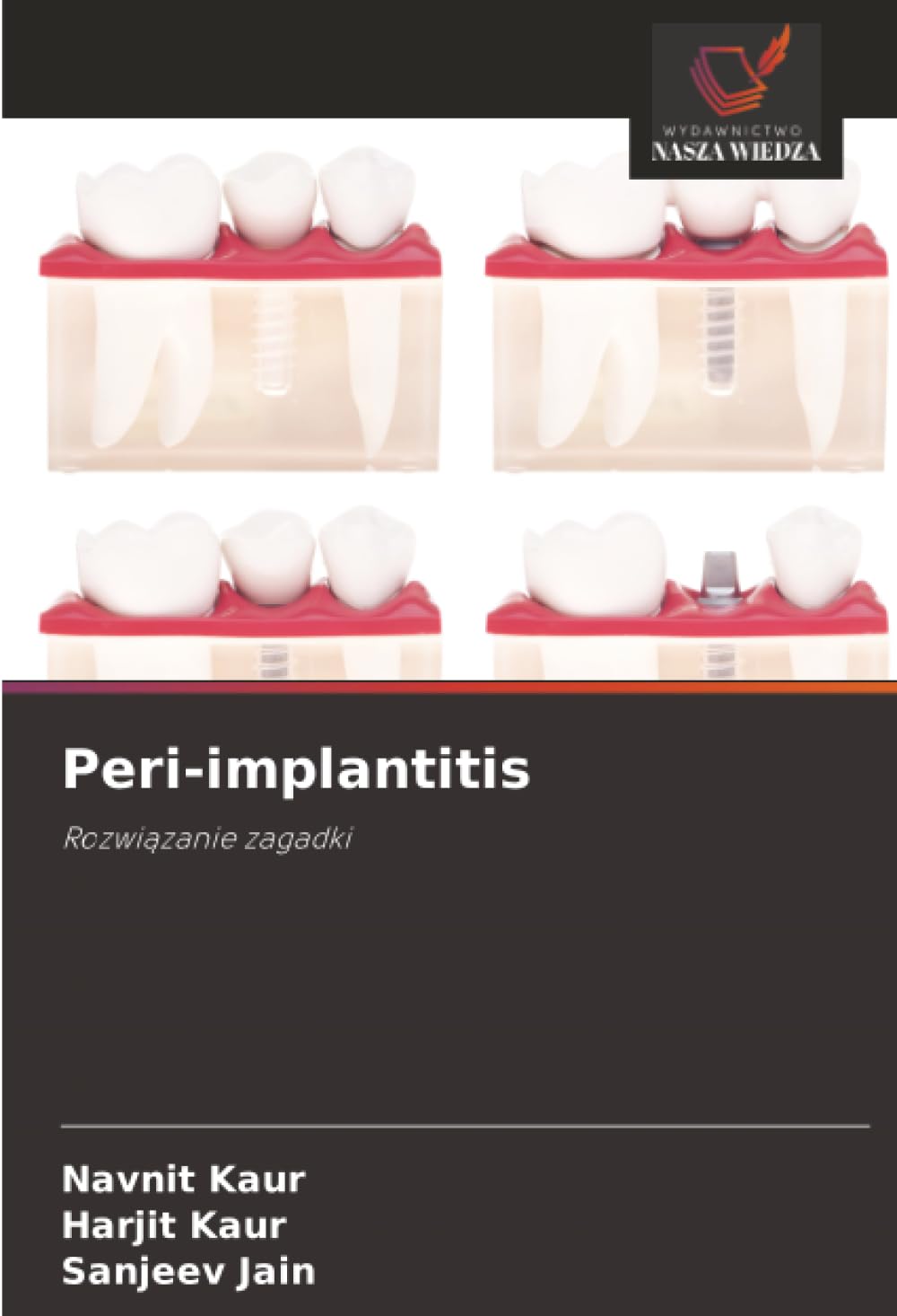 Peri-implantitis: Rozwiązanie zagadki