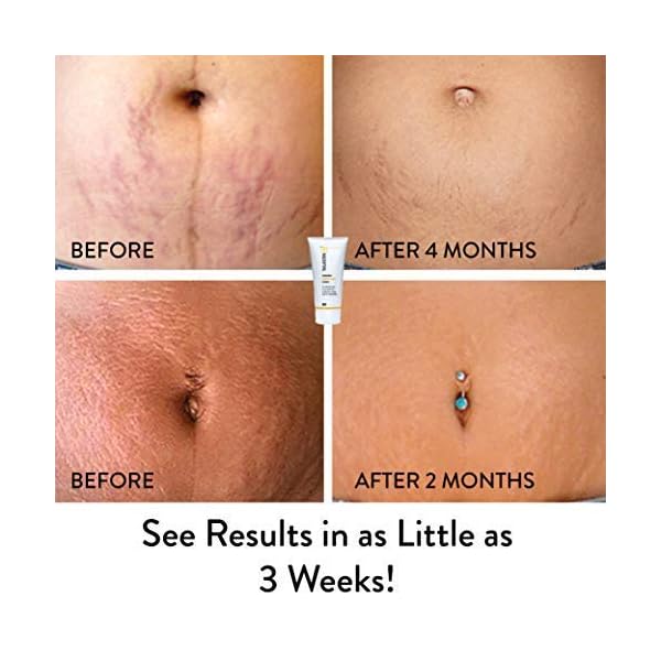 TriLASTIN-SR Intensive Stretch Mark Cream (5.5 oz.) for Pregnancy, Scar Cream and Moisturizing Lotion, Cocoa Butter, Scar Treatment, Hypoallergenic and Paraben-Free