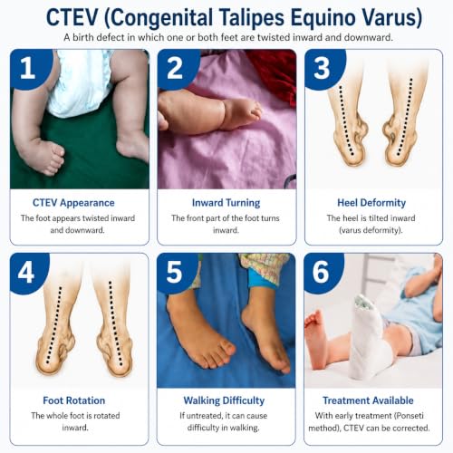 Image of SALO Orthotics CTEV Splint - Clubfoot Brace for Left Foot (Size - 5.5 inch)