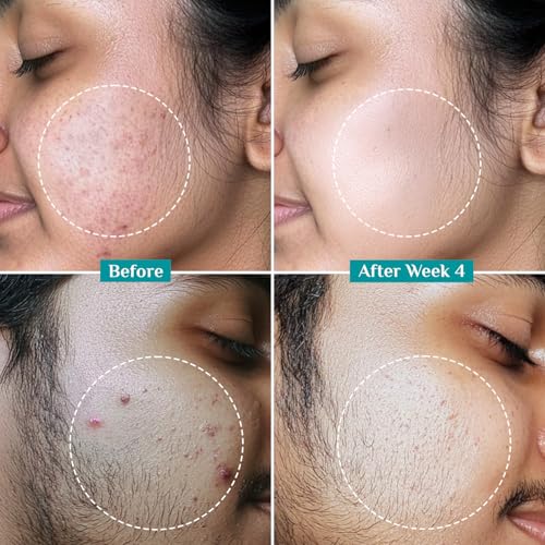 Image of Pilgrim Salicylic Acid 2% + Glycolic Acid 3% Anti Acne Serum For Acne Prone Skin For Unisex Of All Skin Types, Korean Skin Care, 30ml