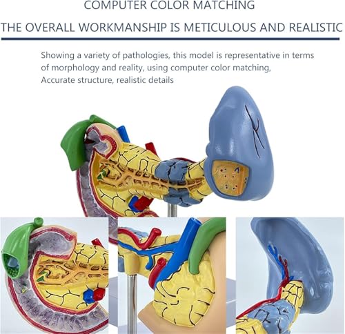 Pancréas pathologique AMITD modèle anatomique avec duodénum pour démonstration médicale - 5