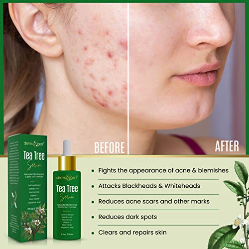 Dermaxgen Tea Tree Serum Organic Formula Natural Vitamin C For Acne Scar, Dark Spots, Blemishes Pimple For Clear, Glowing & Youthful Skin 2 Fl Oz #TOP4