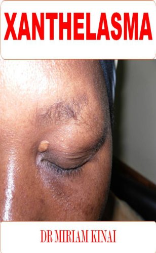 Dermatology: Xanthelasma (Skin Diseases Book 5)