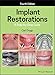 Implant Restorations: A Step-by-Step Guide