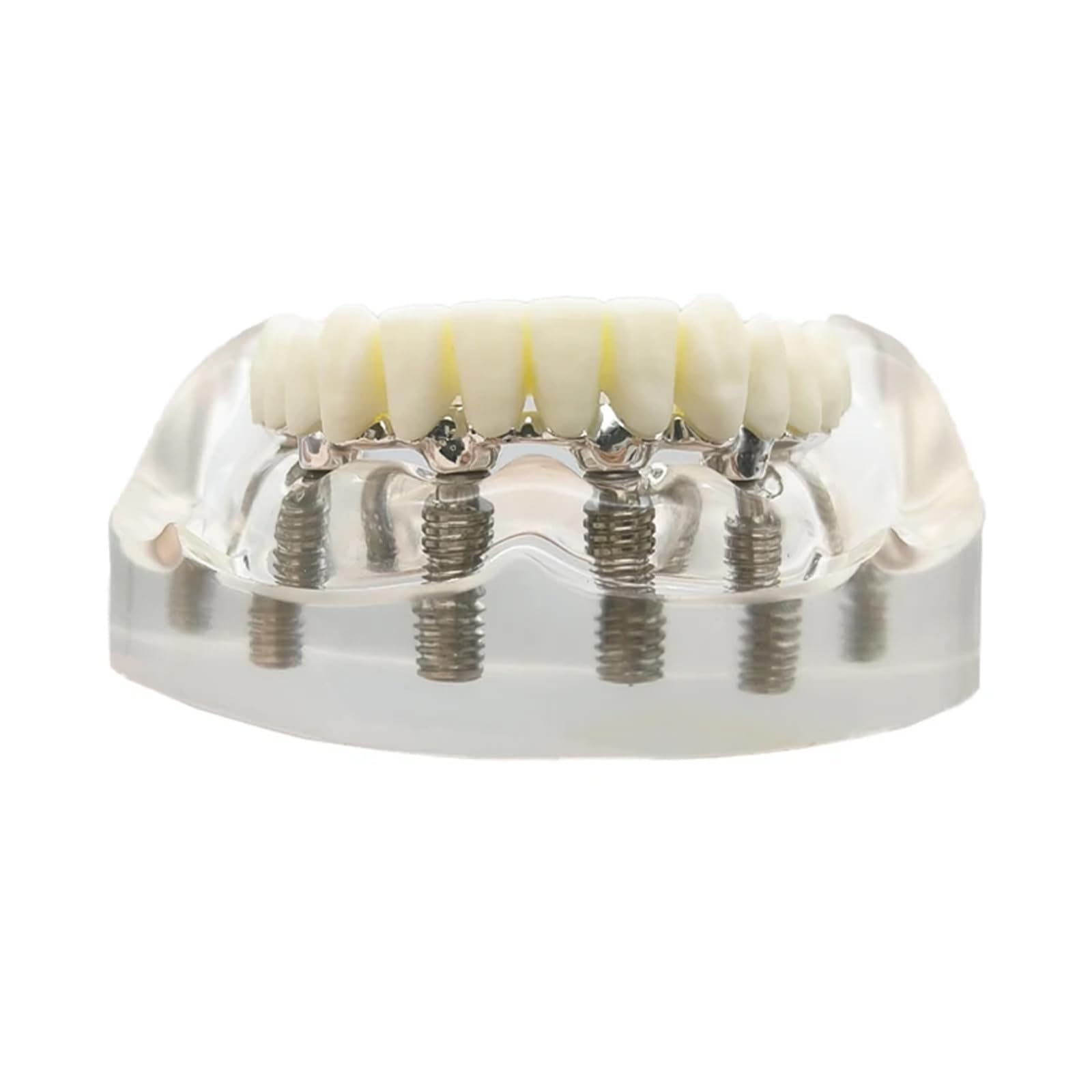 Modello di impianto dentale overdenture mascella inferiore rimovibile con 6 impianti per studio didattico - Strumento di dimostrazione della visione trasparente