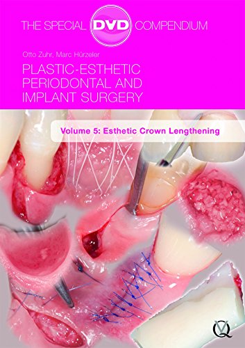 Plastic-Esthetic Periodontal and Implant Surgery, Volume 5: Esthetic Crown Lengthening DVD-ROM – March 29, 2013