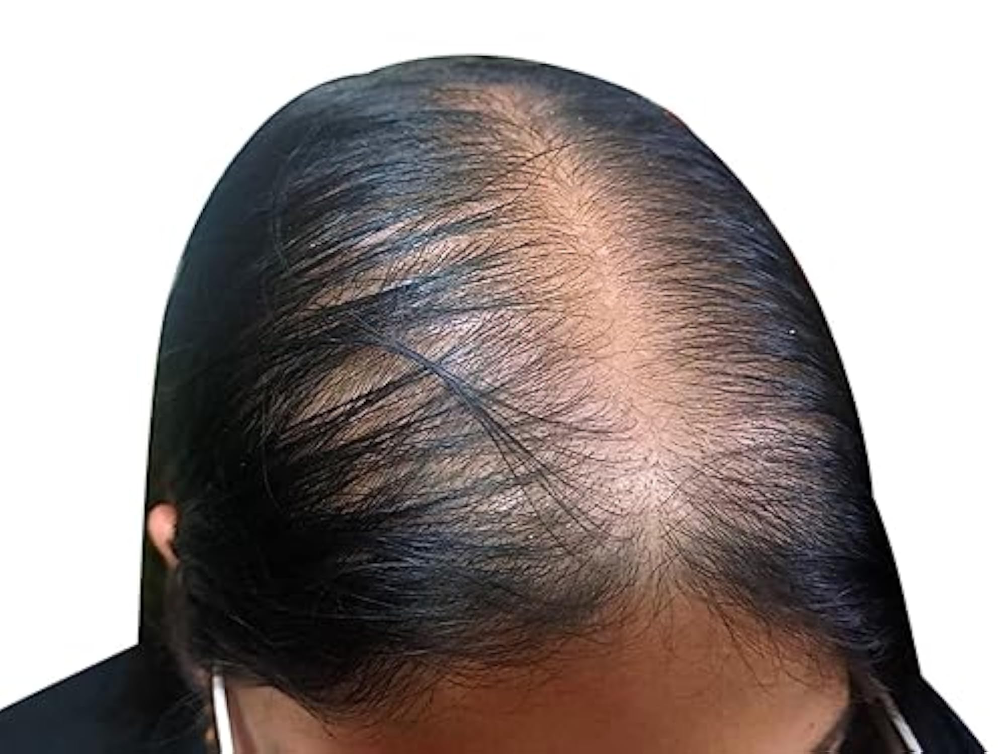 Real Human Hair Toppers for Complete Baldness Cure