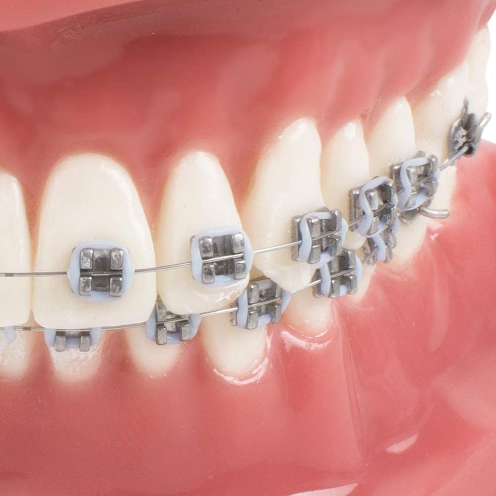 DKULMN Denti dentali Modello ortodontico, Modello dimostrativo ortodontico con staffe in Metallo e Ceramica Modello di interpretazione Orale per Adulti e Bambini''