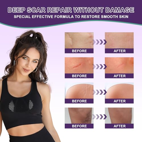 silicone scar cream scar gel - advanced scar gel scar treatment for stretch marks removal old amp new scars surgical scars burns acne c-section keloid scar treatment for women amp men 176oz