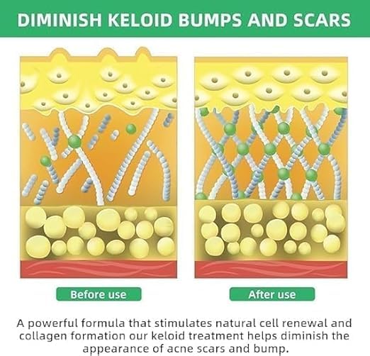 Image of Keloid & Scar Removal Gel - Advanced Silicone Scar Treatment Cream | Fades Acne, Surgery, Injury & Piercing Scars | Smoothens Skin, Reduces Bumps & Marks | 20g Scar Repair Solution (1)