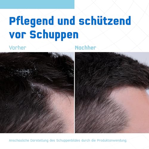 Terzolin Expert Schuppen-Shampoo bei trockener Kopfhaut, Juckreiz und Schuppen, Kosmetikum mit innovativer Pflegeformel, auch bei zu Ekzemen neigender Kopfhaut geeignet – 1 x 200ml