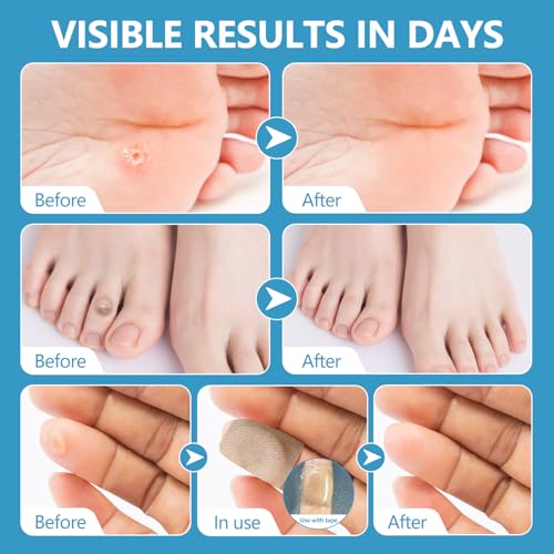 Image of Corn Remover Pads (48 count 2 pack) Plantar Wart Remover for Feet, Corn Removers for Toes with 40% Salicylic Acid, Callus Removal for Feet