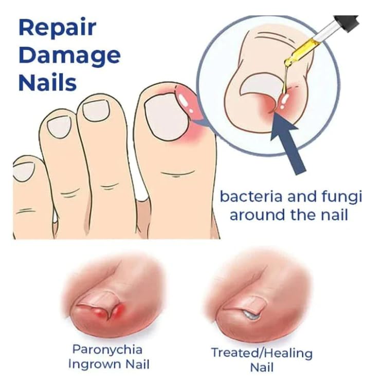 Nozti Anti Paronychia Relief Oil, 10ml, Natural Nail Treatment for Pain Relief and Disinfection - Image 7 thumbnail