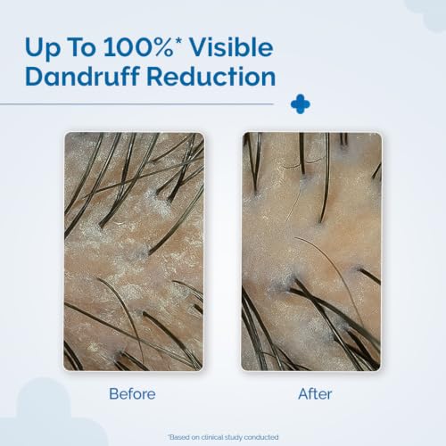 Image of The Derma Co Triple Actives Anti-Dandruff Shampoo | Up To 100%* Dandruff Reduction | 2% Salicylic Acid + 1% Climbazole + 1% Piroctone Olamine & Menthol | ZPTO-Free | pH 5.5, Non-Drying & Sulphate-Free formula | Suitable for Men & Women | 200 ml