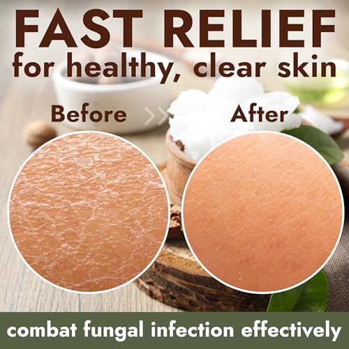 Image of Antifungal Soap Infused with Shea Butter 1% Tolnaftate for Deep Cleansing | Medicated Jock Itch Treatment, Helps Fight Ringworm & Athlete's Foot, for Deep Cleansing, 2 Antifungal Bars with Scrubber