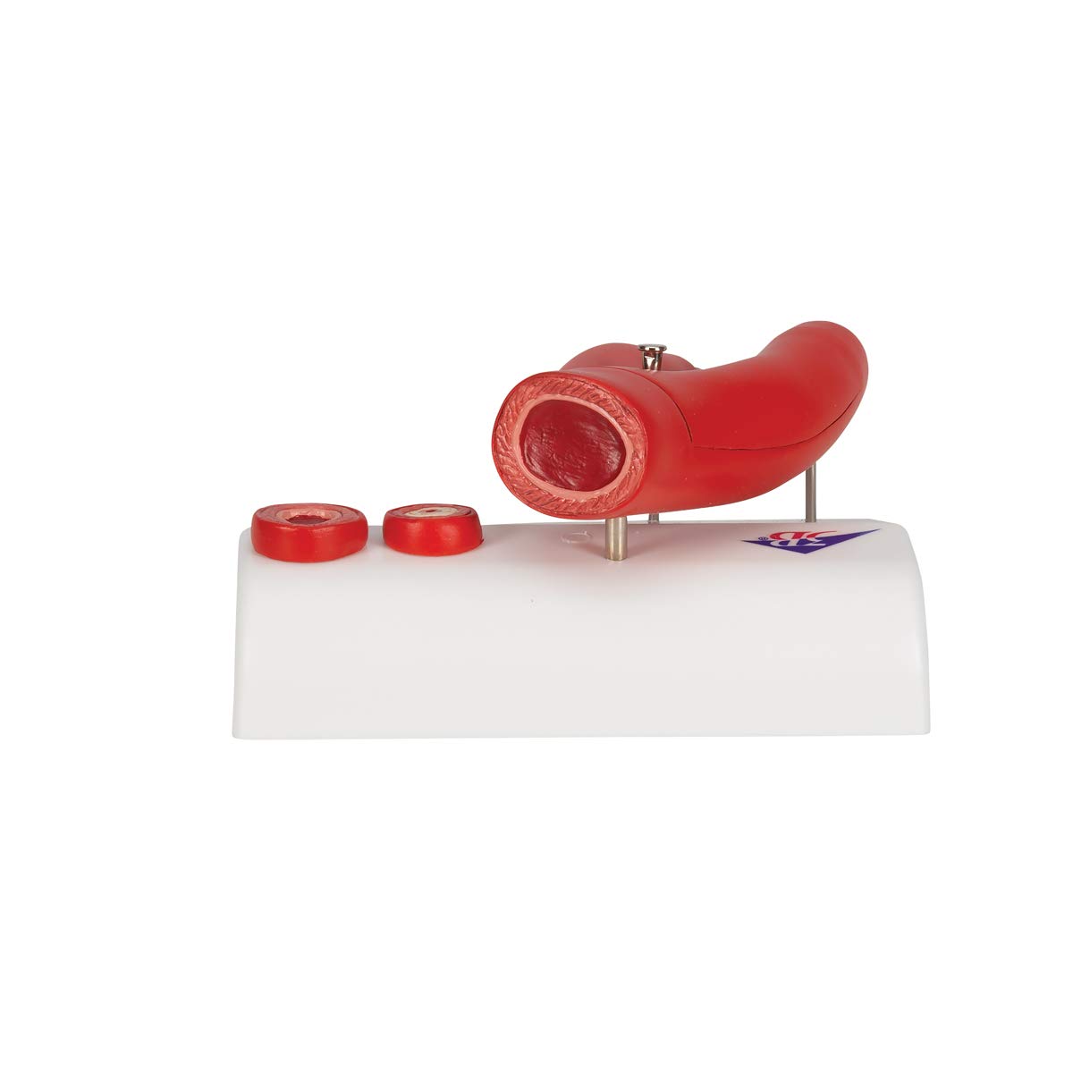 3B Scientific G40 Arteriosclerosis Model on Base - 3B Smart Anatomy