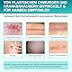 Silikon Narbenpflaster (1.6 X 75 Scar Roll-1.9m) Professionelle Narbenentfernung Behandlung für Keloid, C-Sektion, Chirurgie, Burn, Akne Et