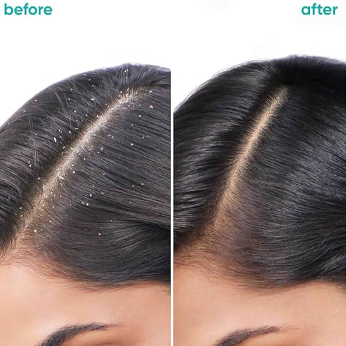 Biolage Scalppure PROFESSIONAL Anti-Dandruff Serum | 72 HRS Scalp Detox | 6-in-1 Formula | Paraben-free & Vegan | Serum for Men & Women, 100ml - Image 3