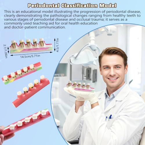 Image of Periodontal Disease Classification Model, 5-Stage Dental Anatomy Model for Dental Education,Dental Training,Demonstrations,Oral Care Education