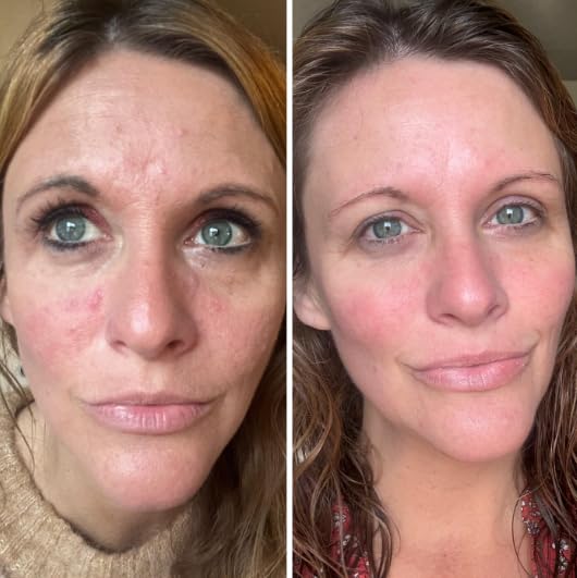 Generic Crema para el Acne en La Cara, Crema para Acne en La Cara, Tratamiento Para El acne, Face Moisturizers, 30ml/1OZ