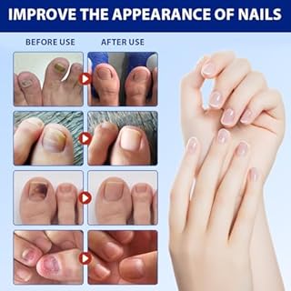 GXGM 42 Pezzi Fungal Nail Patches, Toppe Fungine per Unghie, Toppe per Unghie Fungo, Cerotti Multiuso per la Riparazione Delle Unghie dei Piedi Danneggiate Delle Unghie Scolorite